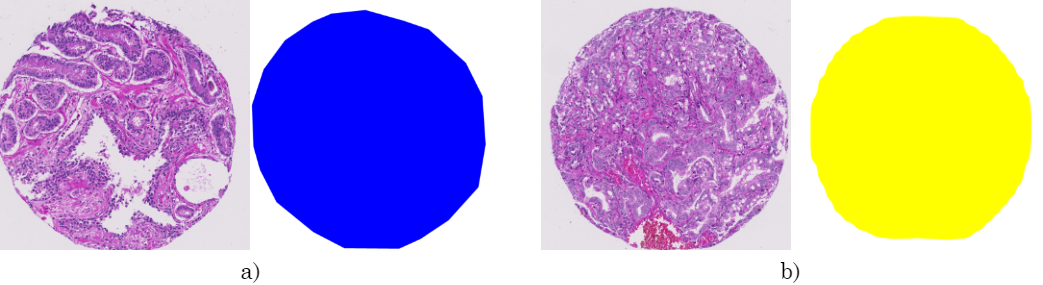 Ejemplos para el primer nivel de representación. a) Ejemplo de dato de entrenamiento: imagen histológica completa con su respectiva máscara de anotación (azul - Gleason 3) realizada por un experto patólogo. b) Ejemplo de dato de prueba: imagen histológica completa y su máscara predicha (amarillo - Gleason 4)